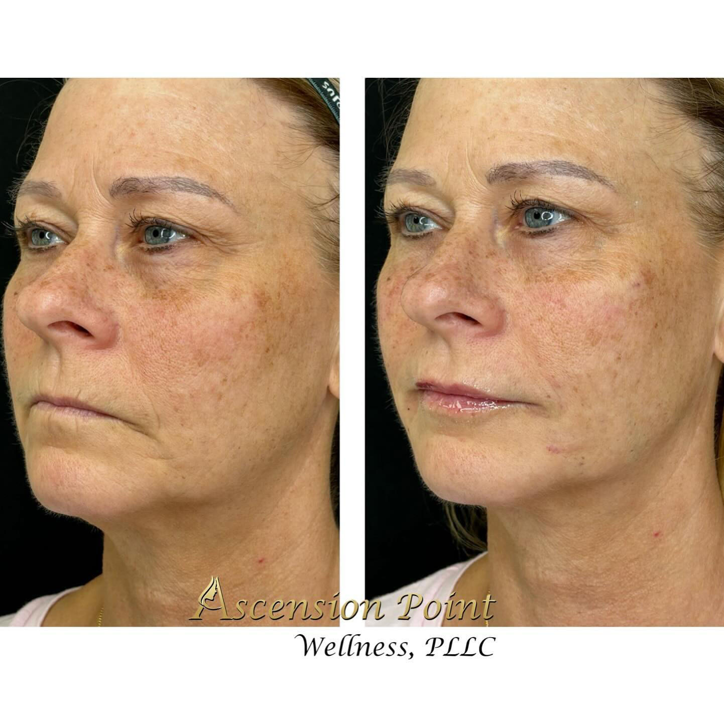 Facial balancing (RHA Collection fillers)