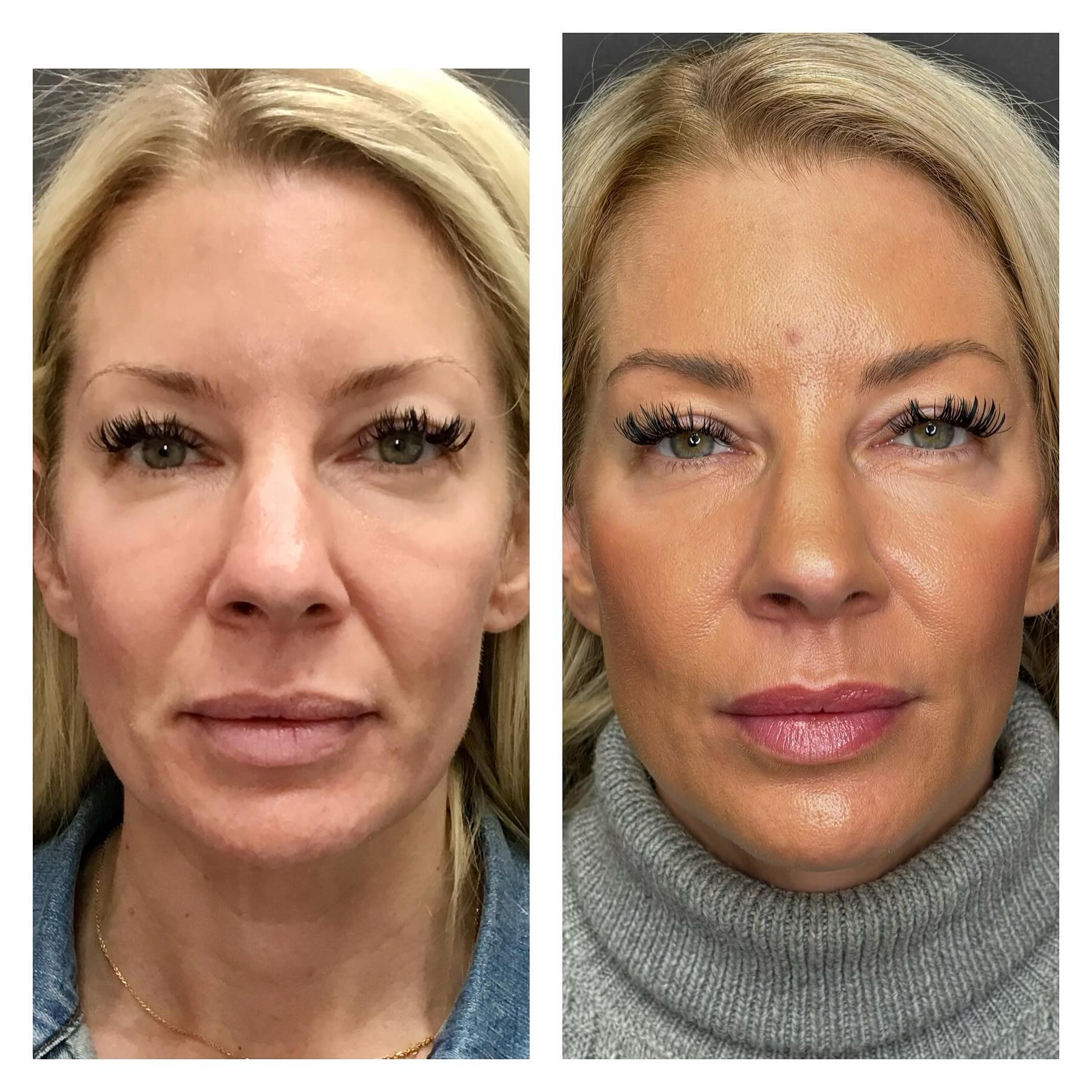 Facial balancing (RHA Collection fillers)