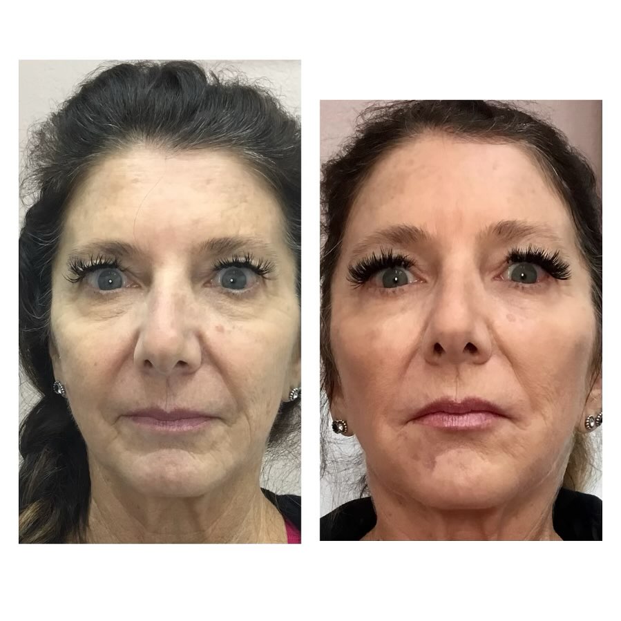 Facial balancing (RHA Collection fillers)
