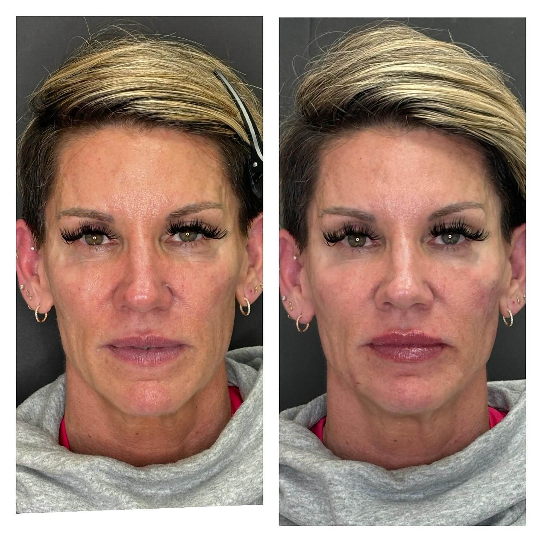 Facial balancing (RHA Collection fillers)