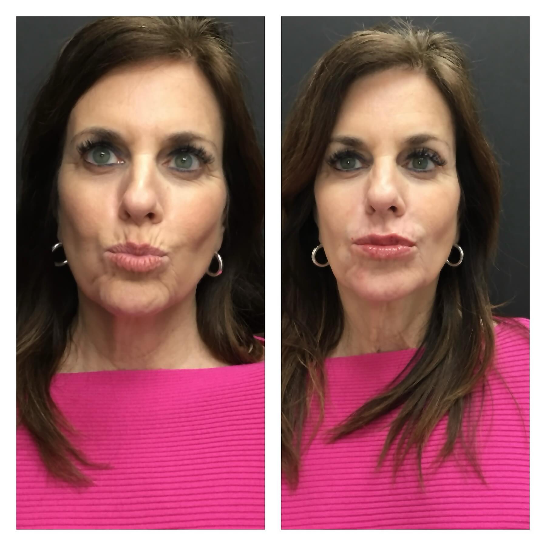 Perioral lines, chin and lip filler