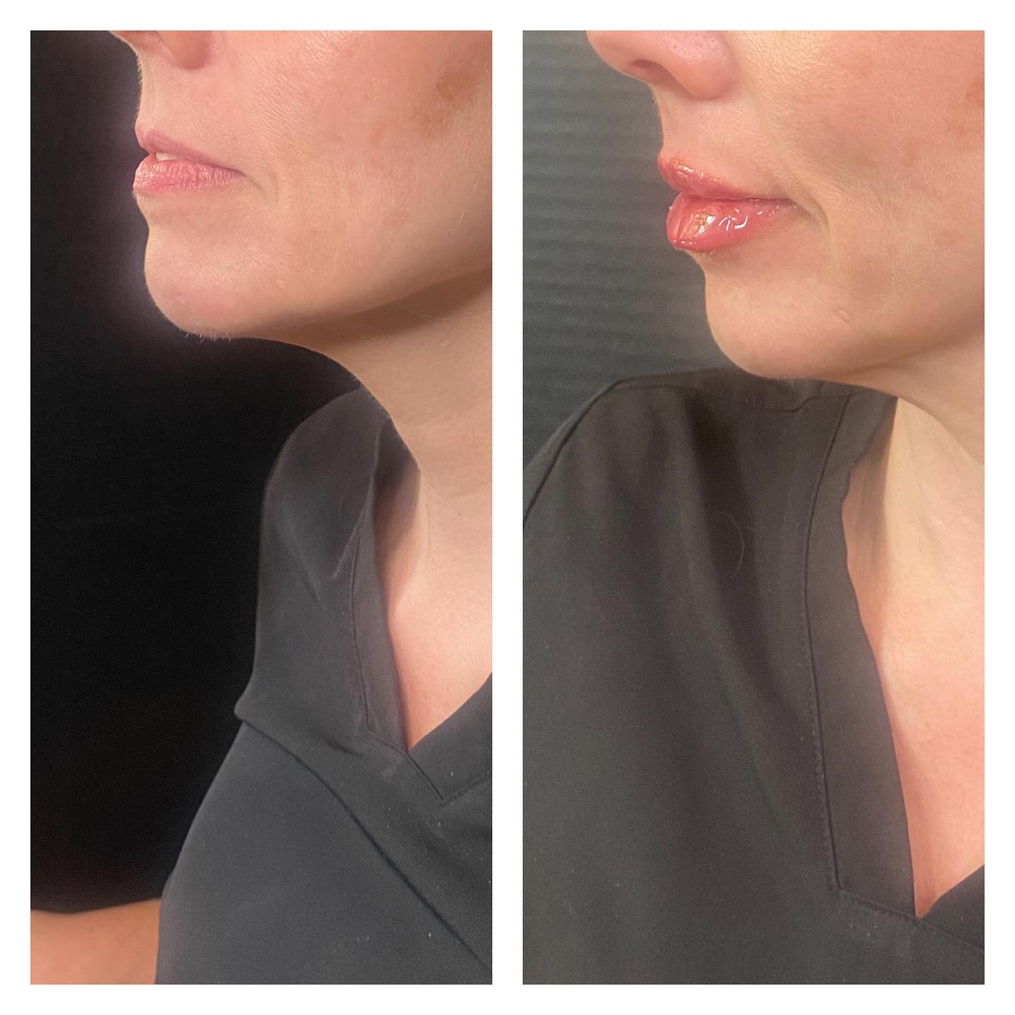 Lip Filler (Versa)