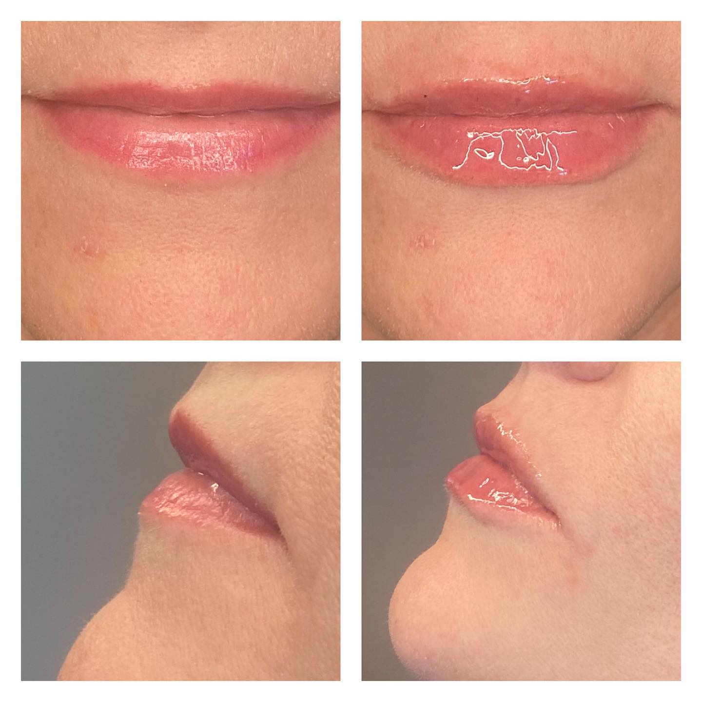 Lip filler (Versa)