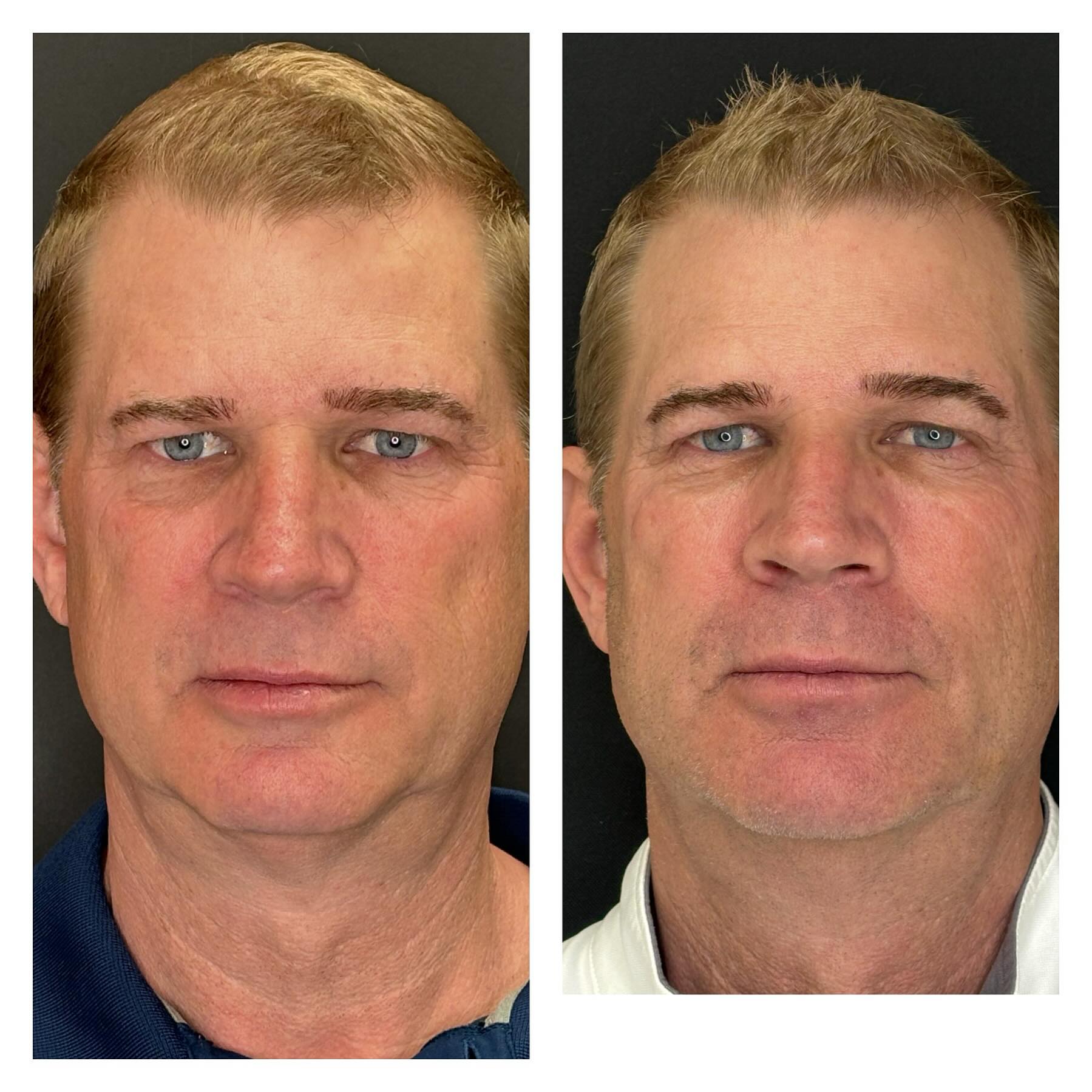 Facial Balancing (RHA Collection fillers)